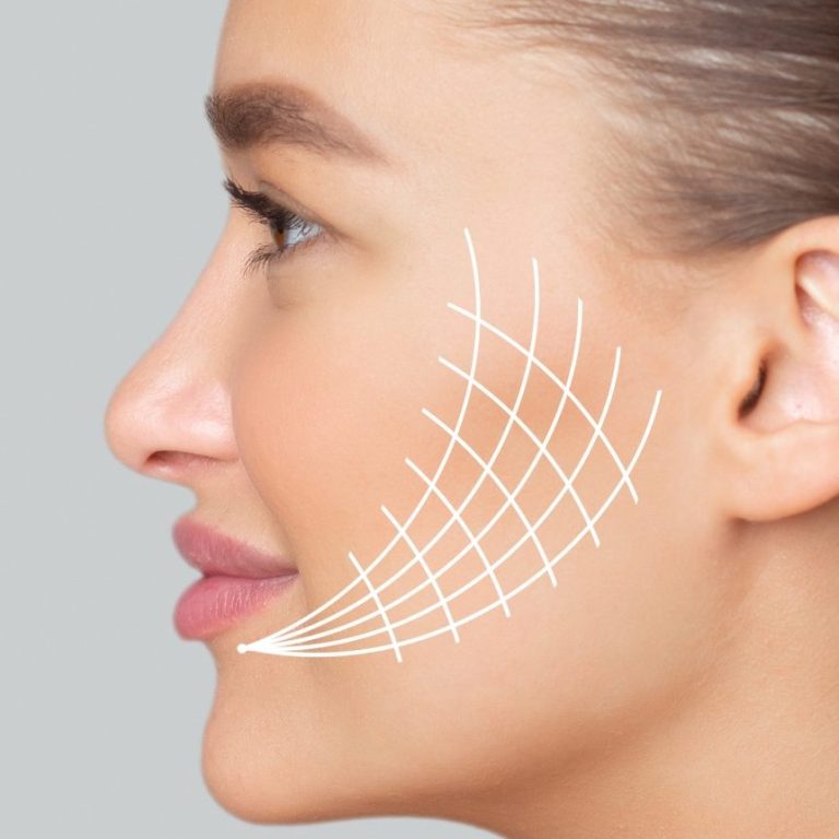 Aptos Fadenlifting zur Gesichtsstraffung. Praxis für Ästhetik und Anti-Aging, Hamburg-Eppendorf. Profilansicht einer Frau mit sanften Gesichtszügen und einem grafischen Linienmuster.