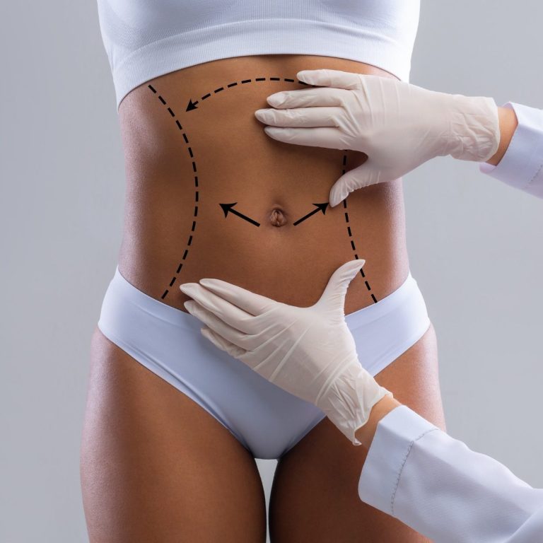 Ästhetische Behandlungen für Körperformung. Praxis für Ästhetik und Anti-Aging, Hamburg -Eppendorf. Behandlung des Bauches mit Markierungen und Händen eines Arztes in Handschuhen.